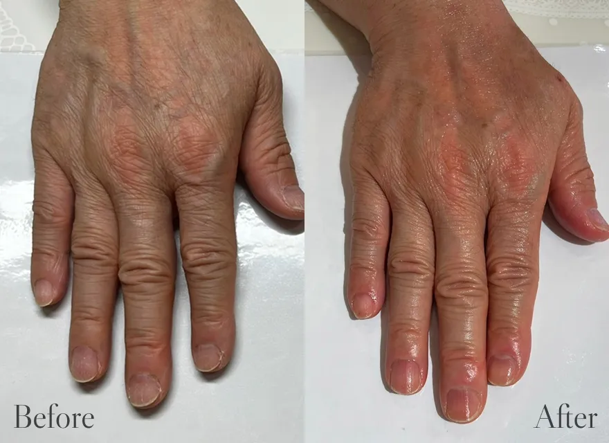 極上ハンドリプロ施術結果