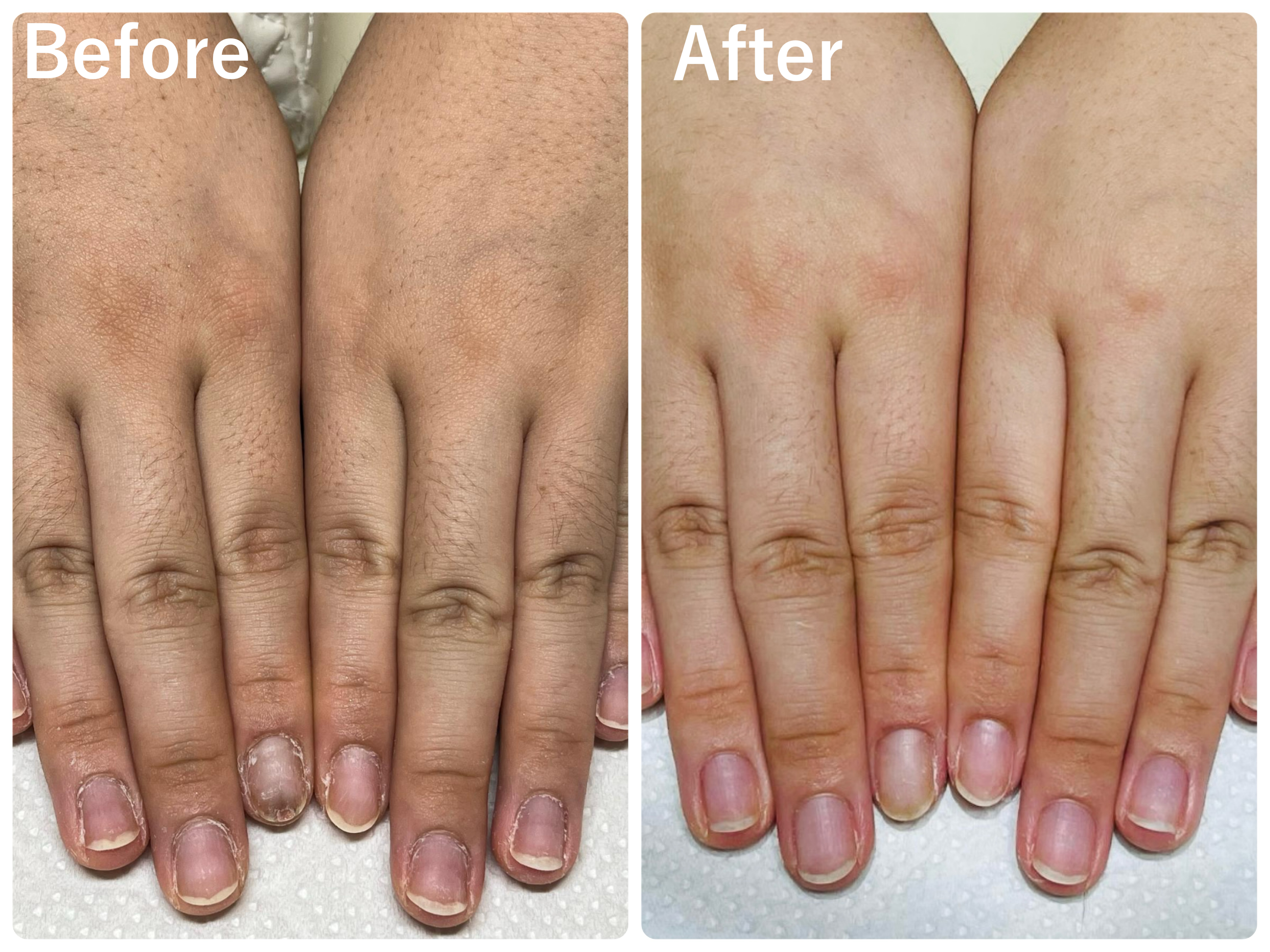20代女性　こんなに1回で変わるって感動　指の横溝の黒ずみやしわが目立ちにくくなった（お客様の声）