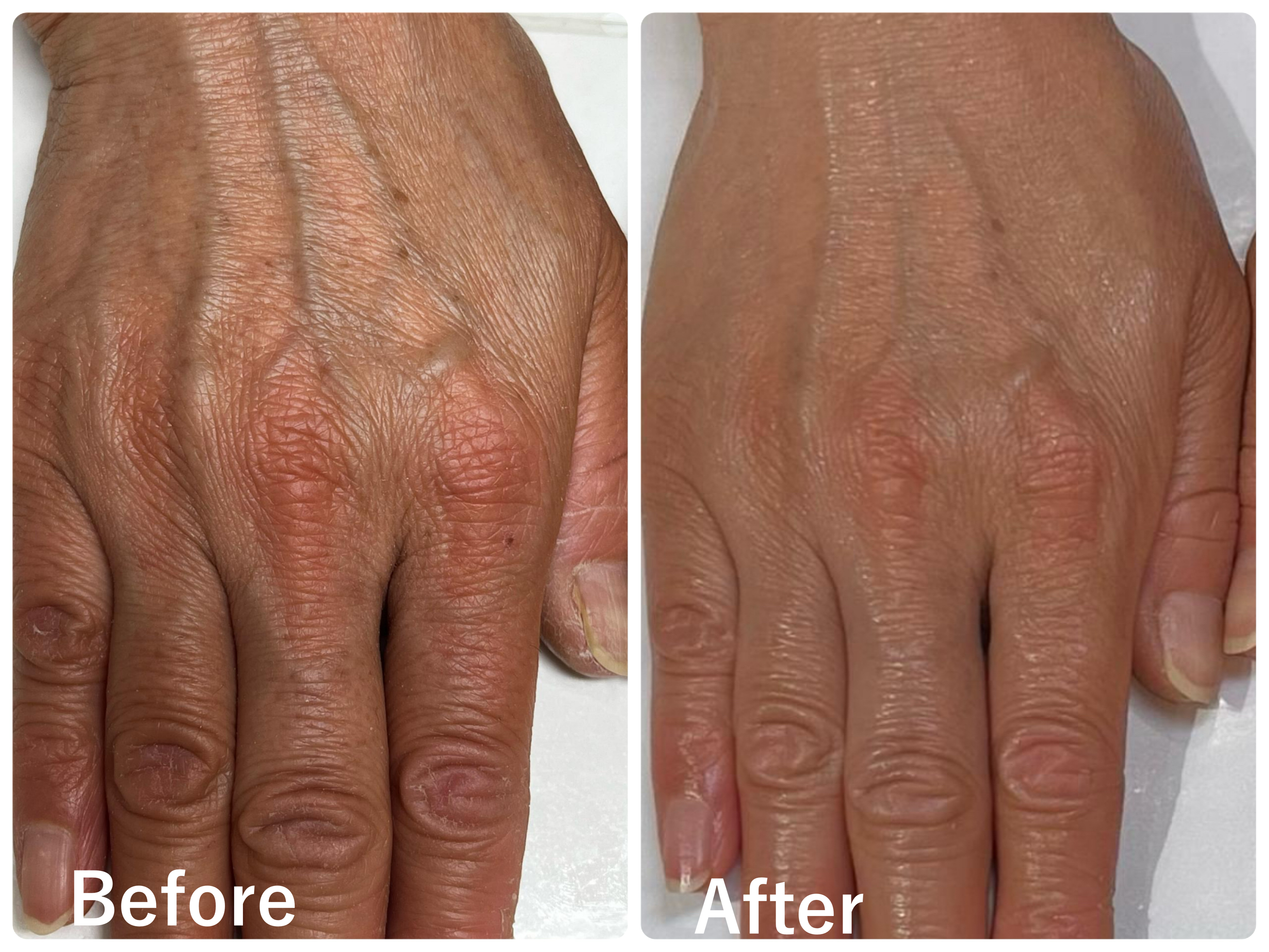 50代女性　指先と指の関節にあった荒れとあかぎれの悩みが解消されました（お客様の声）