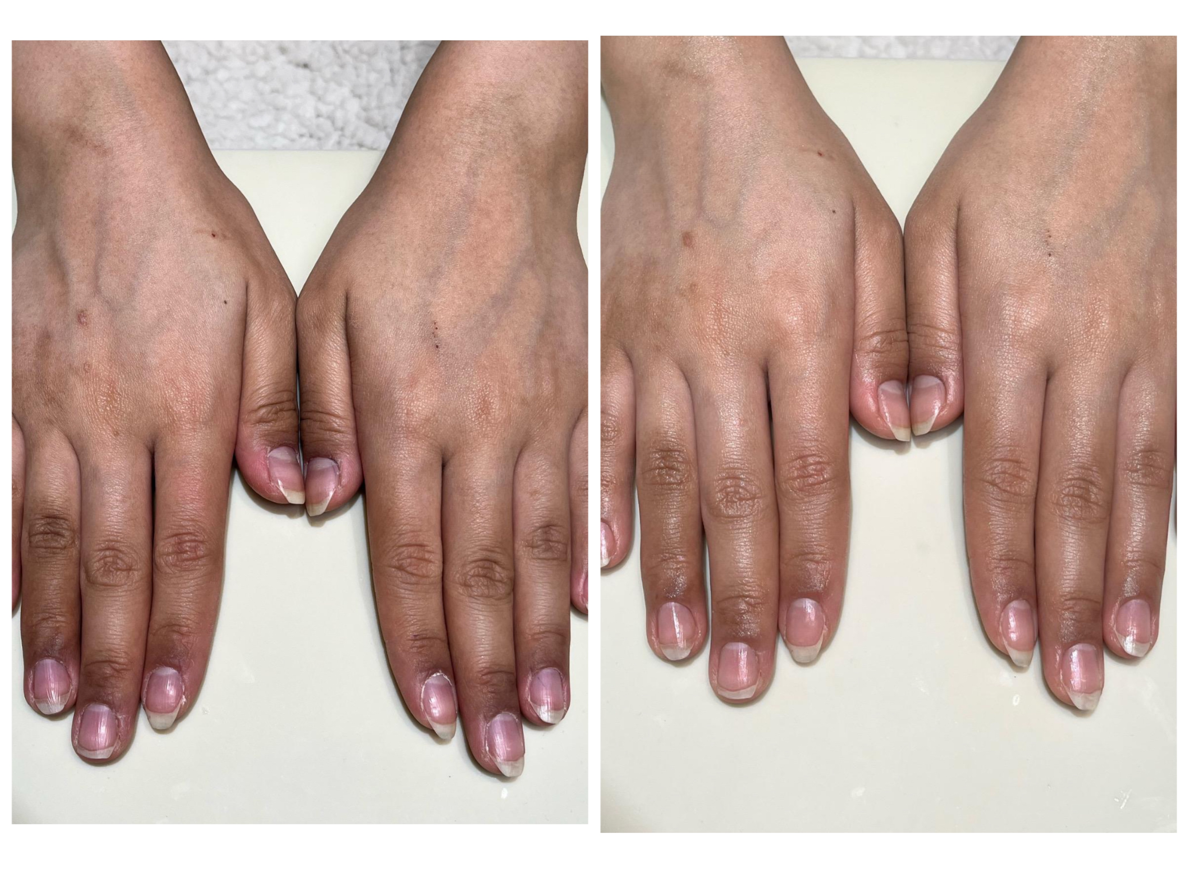 指の黒ずみで悩むお客様と初回の変化