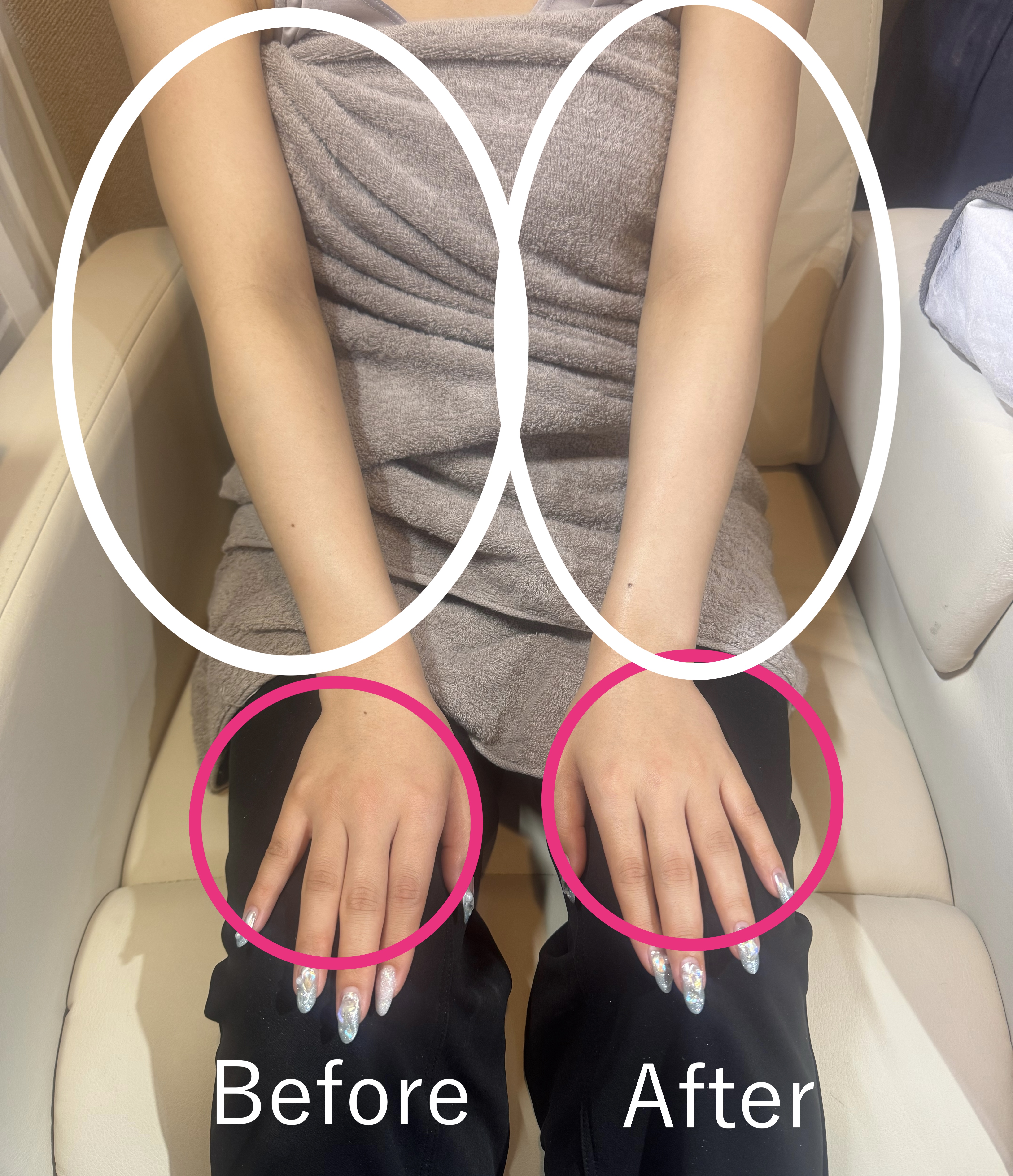 極上ハンドリプロは“手の再生美容のビフォーアフター