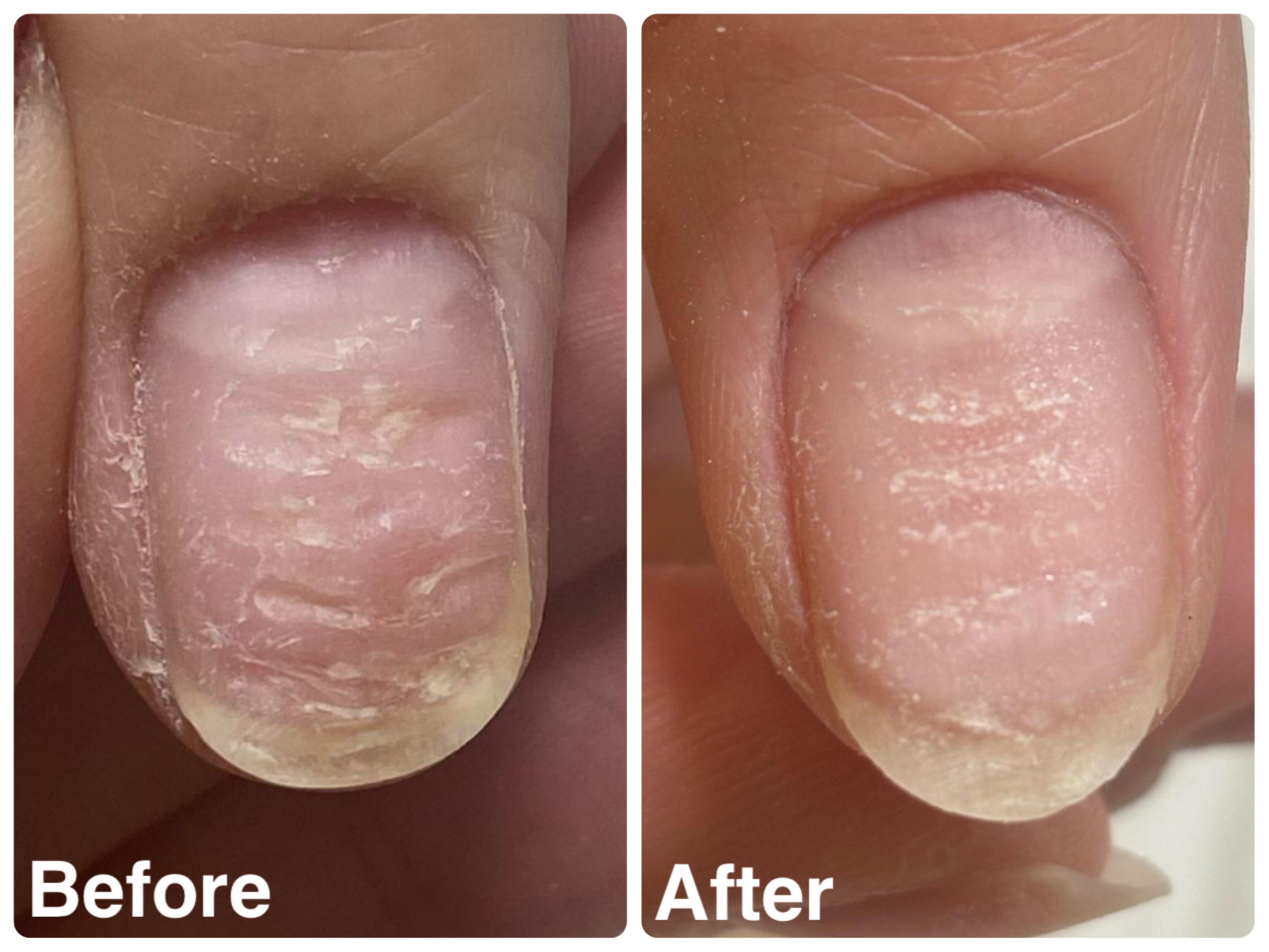 40代女性　凹凸爪は隠すしかないと思っていた私が、根元から変われた理由（お客様の声）