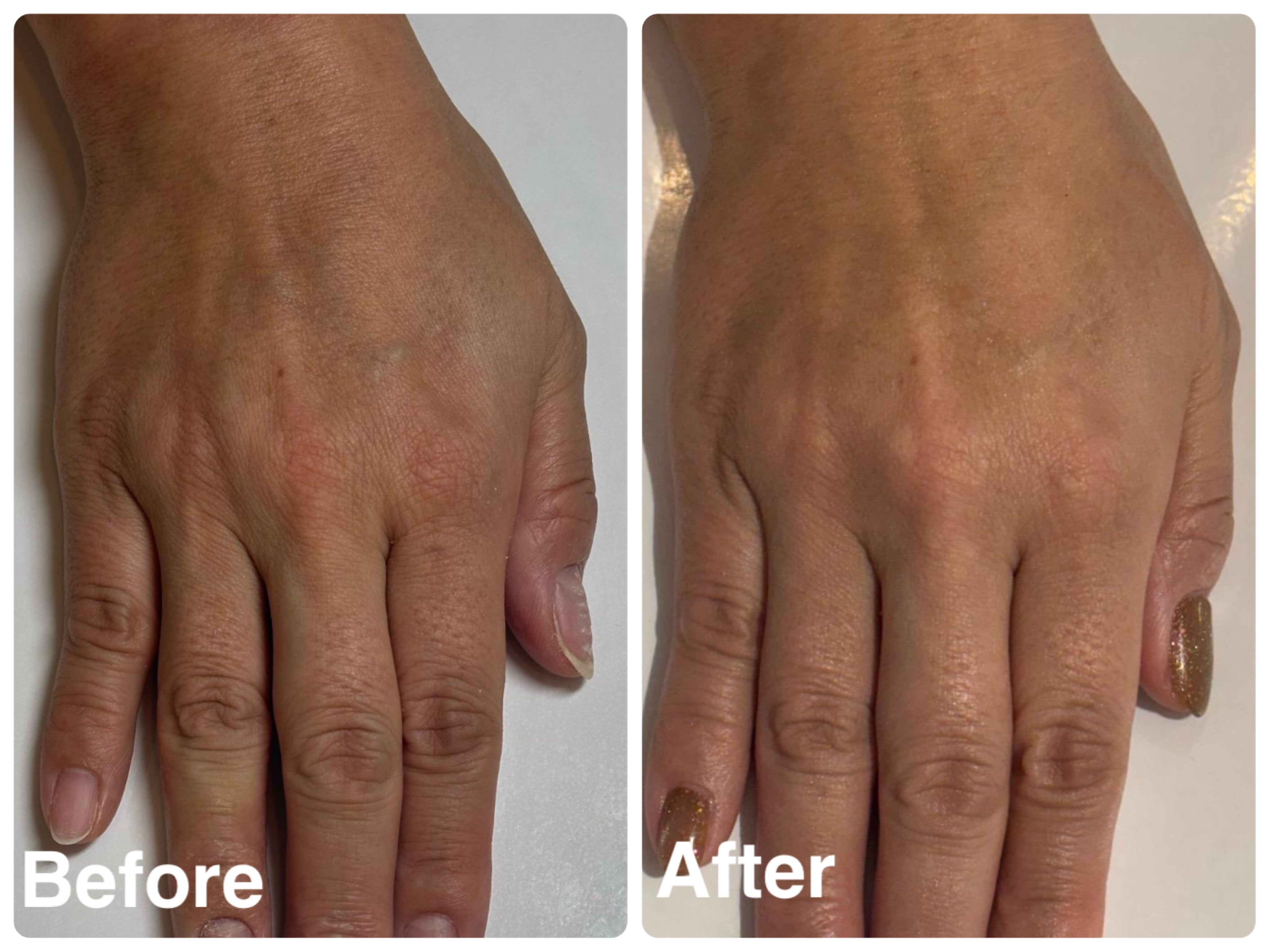 極上ハンドリプロコース3回目施術ビフォーアフター